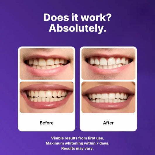 Purple Whitening Strips