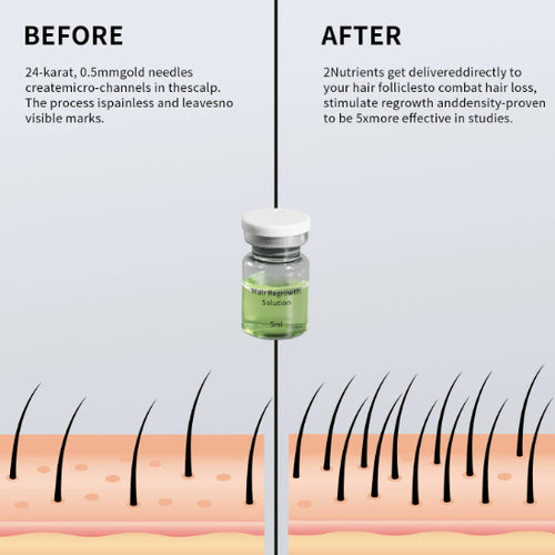 AlphaHair™ Micro Infusion Kit